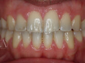 After - Ali Orthodontics Dental