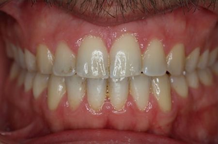 After - Ali Orthodontics Dental