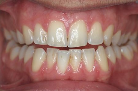 Before - Ali Orthodontics Dental