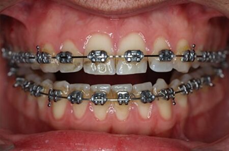 During - Ali Orthodontics Dental