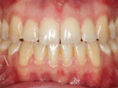 After - Ali Orthodontics Dental