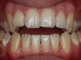 After - Ali Orthodontics Dental