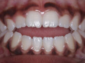 After - Ali Orthodontics Dental