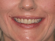 After - Ali Orthodontics Dental