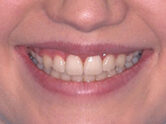 After - Ali Orthodontics Dental