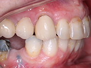 After - Ali Orthodontics Dental