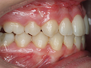 After - Ali Orthodontics Dental