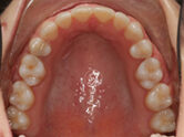 After - Ali Orthodontics Dental