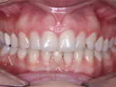 Before - Ali Orthodontics Dental