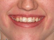 Before - Ali Orthodontics Dental