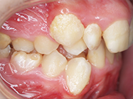 Before - Ali Orthodontics Dental