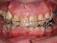 After - Ali Orthodontics Dental