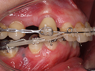 After - Ali Orthodontics Dental