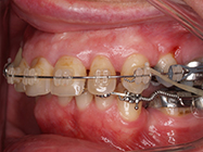 After - Ali Orthodontics Dental