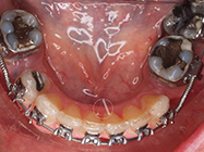 After - Ali Orthodontics Dental