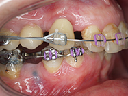 After - Ali Orthodontics Dental