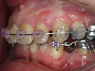 After - Ali Orthodontics Dental