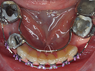 After - Ali Orthodontics Dental