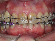 After - Ali Orthodontics Dental