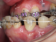 After - Ali Orthodontics Dental