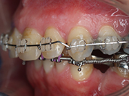 After - Ali Orthodontics Dental