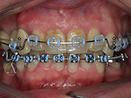 After - Ali Orthodontics Dental