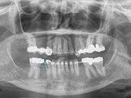 After - Ali Orthodontics Dental