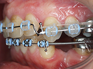 After - Ali Orthodontics Dental