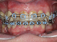 After - Ali Orthodontics Dental
