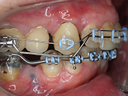 After - Ali Orthodontics Dental