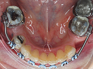 After - Ali Orthodontics Dental