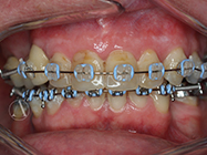 After - Ali Orthodontics Dental