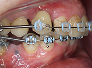 After - Ali Orthodontics Dental