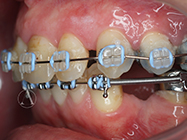 After - Ali Orthodontics Dental