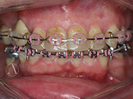 After - Ali Orthodontics Dental
