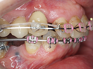 After - Ali Orthodontics Dental