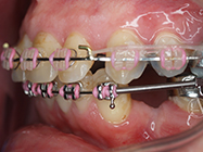 After - Ali Orthodontics Dental