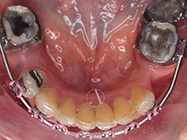 After - Ali Orthodontics Dental