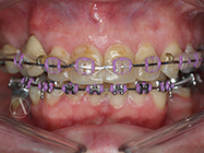 After - Ali Orthodontics Dental