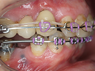 After - Ali Orthodontics Dental