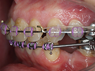 After - Ali Orthodontics Dental