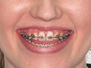 After - Ali Orthodontics Dental