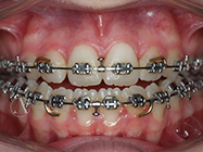 After - Ali Orthodontics Dental