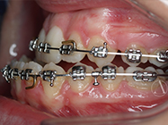 After - Ali Orthodontics Dental