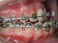 After - Ali Orthodontics Dental