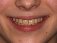After - Ali Orthodontics Dental
