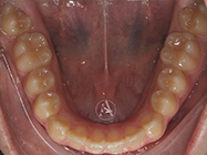 After - Ali Orthodontics Dental