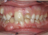 Before - Ali Orthodontics Dental