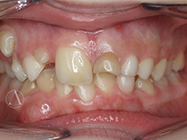 Before - Ali Orthodontics Dental