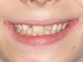 Before - Ali Orthodontics Dental